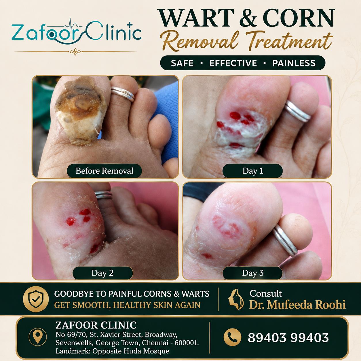 Corn removal before and after at Zafoor Clinic Chennai