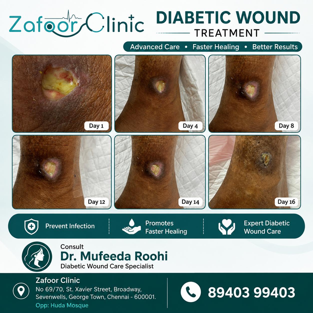 Diabetic wound care before and after at Zafoor Clinic Chennai