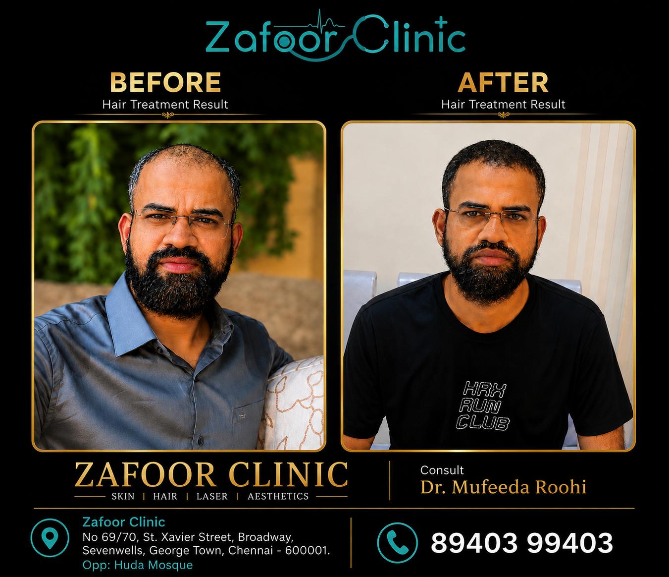 Hair treatment result before and after at Zafoor Clinic Chennai