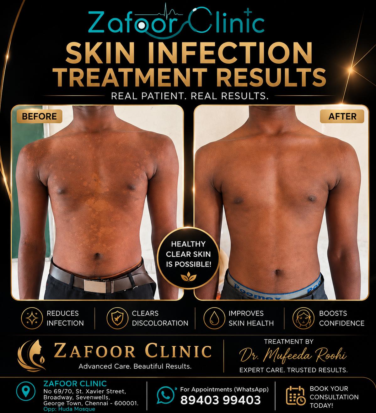 Skin infection treatment before and after at Zafoor Clinic Chennai