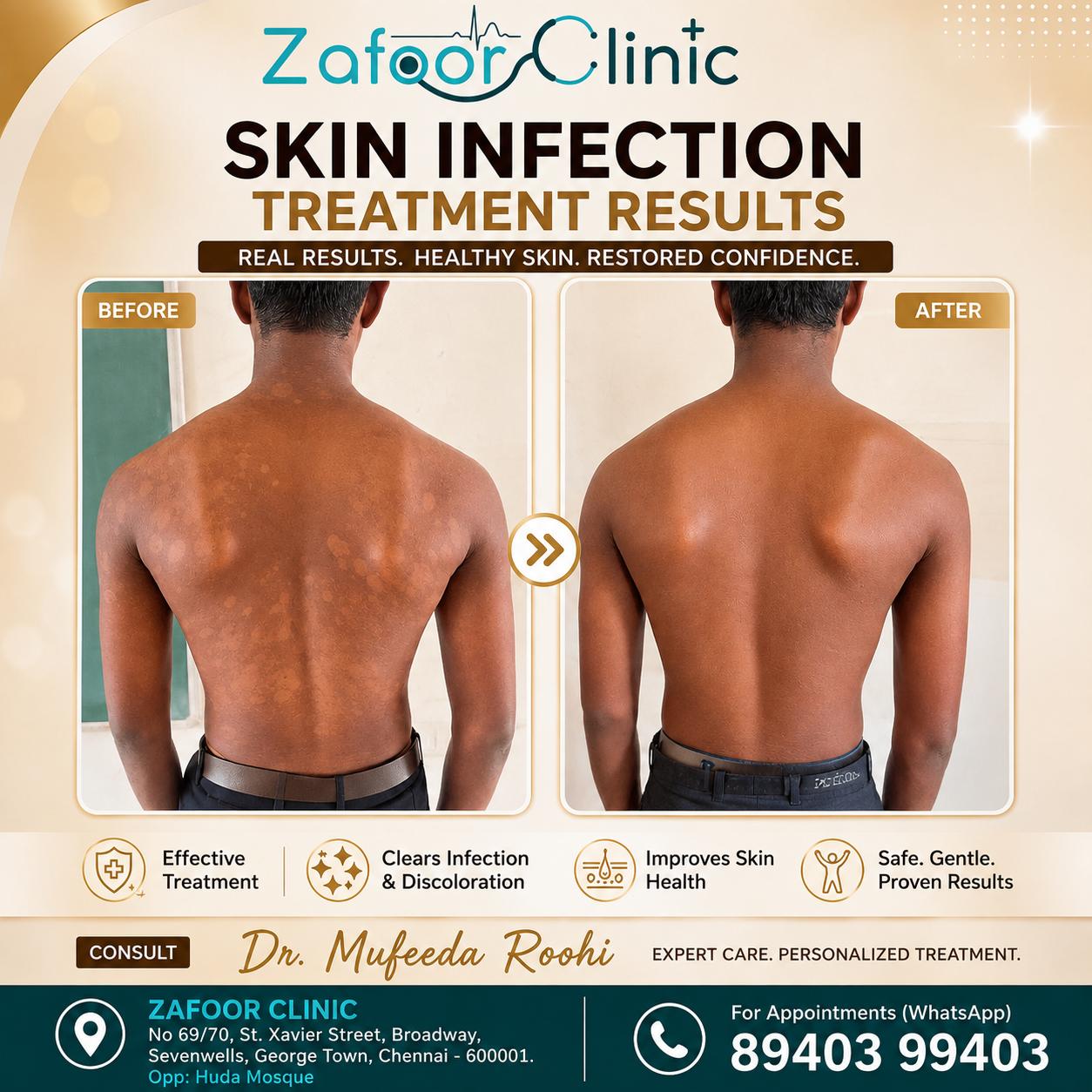 Skin infection treatment before and after at Zafoor Clinic Chennai