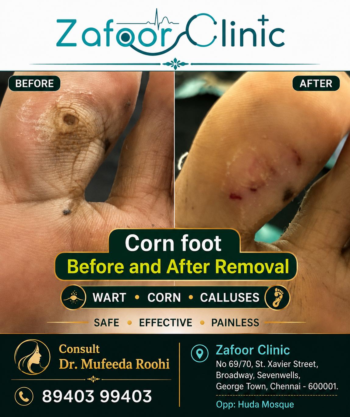 Wart removal before and after at Zafoor Clinic Chennai