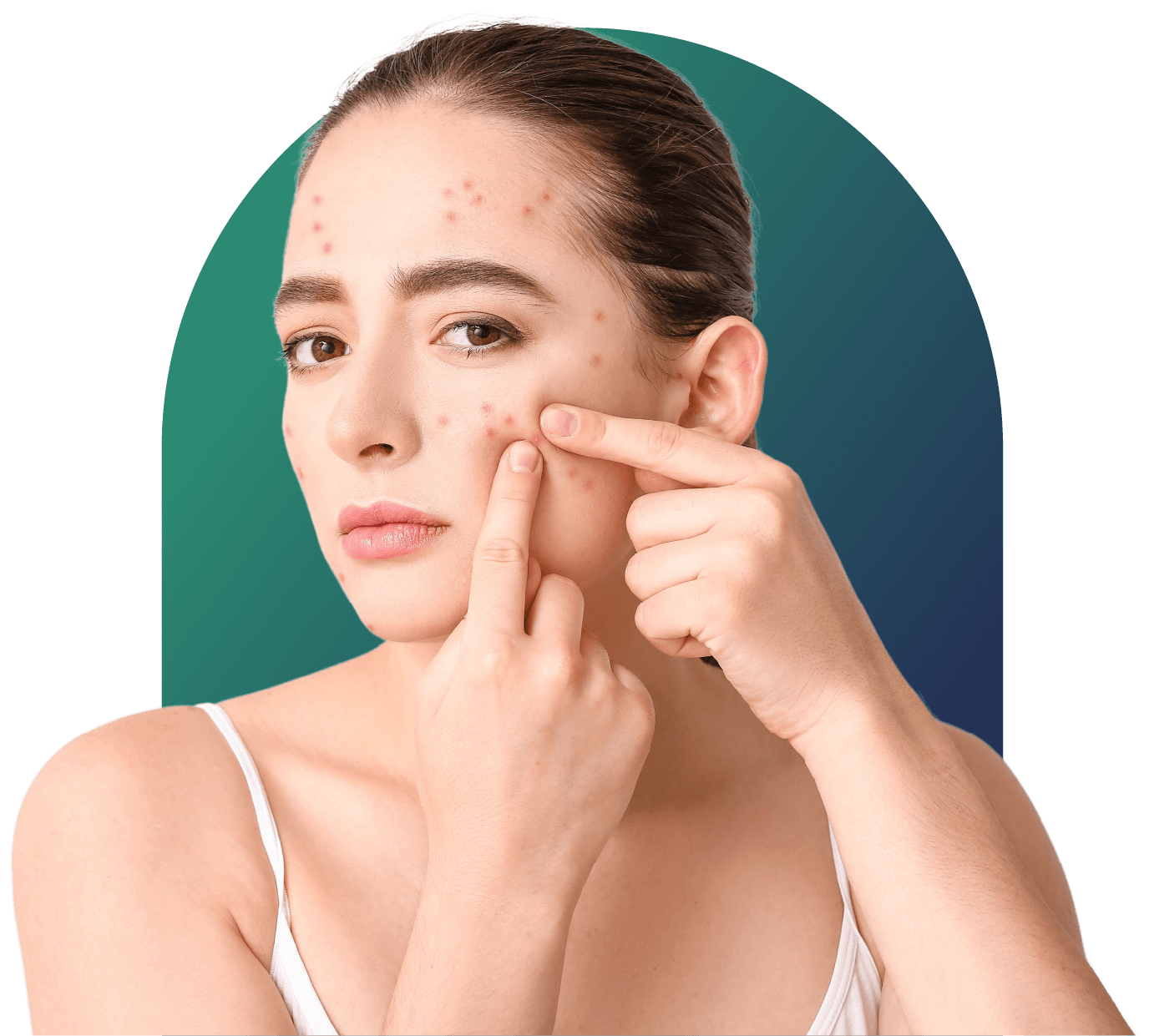 Acne / Pimples Treatment